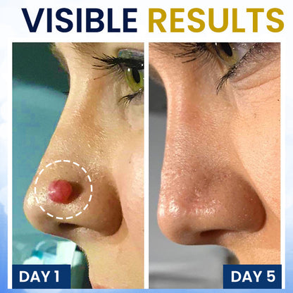 AEXZR® Skin Tag Cryo Treatment Spray🧊 Precision Cryo-Tech: Freezes Away Skin Tags & Warts in Seconds – No Blades, No Pain.